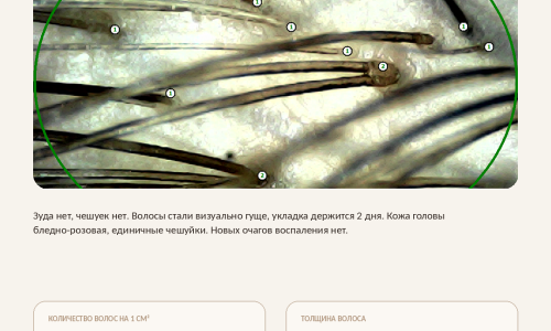 Когда перхоть - это не просто перхоть?
