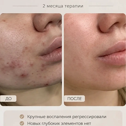 Акне, которое беспокоило 7 лет — результат лечения за 2 месяца